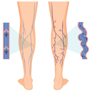 Varices en las piernas